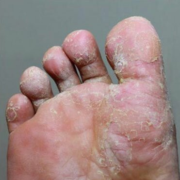 Athlete Foot